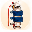 Fracture Vertebrae