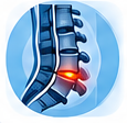 Lumbar Disc Herniation