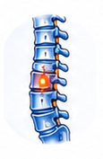 Spinal Cord Injuries
