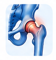 Hip Bursitis