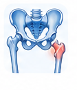 Ischial Bursitis