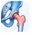 Hip Labral Tear