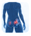 Piriformis Syndrome