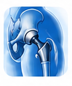 Post-Surgery Hip Rehabilitation