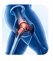 Tendonitis (Hip or Back)